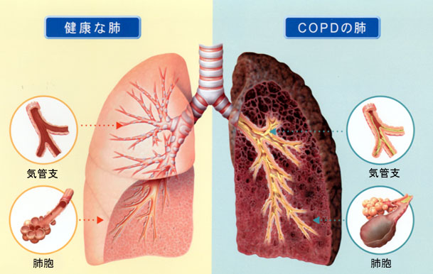 健康な肺とCOPDの肺